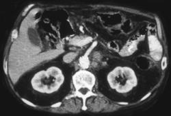 Gastric Carcinoma With Nodes - CTisus CT Scan