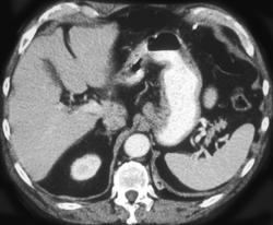 Gastric Adenocarcinoma - CTisus CT Scan