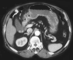 Antral Ulcer (benign) - CTisus CT Scan