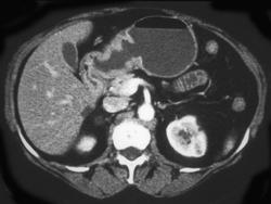 Antral Carcinoma With 3D - CTisus CT Scan