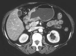 Antral Carcinoma - CTisus CT Scan