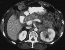 Lymphoma Involves Stomach and Pancreas - CTisus CT Scan