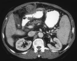 Hepatoma Metastatic to the Stomach - CTisus CT Scan