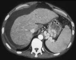 Gastric Varices - CTisus CT Scan