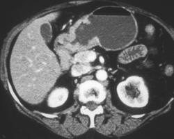 Gastric Adenocarcinoma - CTisus CT Scan