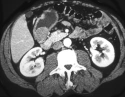 Leiomyoma - CTisus CT Scan