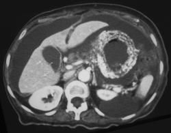 Gastric Adenocarcinoma With Peritoneal Seeding - CTisus CT Scan