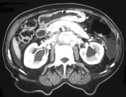 Enhancing Gastric Adenocarcinoma - CTisus CT Scan