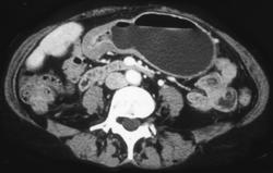 Infiltrate of Gastric Antrum By Adenocarcinoma - CTisus CT Scan