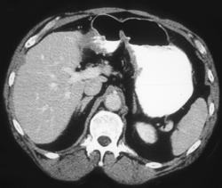 Infiltrating Gastric Adenocarcinoma - CTisus CT Scan