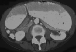 Gastric Outlet Obstruction - CTisus CT Scan