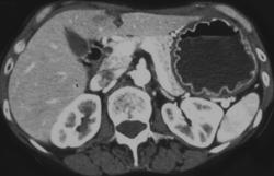 Infiltration of the Stomach By Tumor - CTisus CT Scan