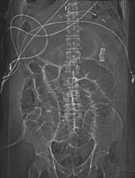 Foreign Body in Left Upper Quadrant (sponge) Simulates the Stomach - CTisus CT Scan