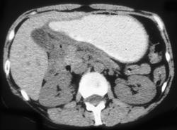 Antral Carcinoma - CTisus CT Scan