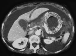 Mucinous Gastric Adenocarcinoma - CTisus CT Scan