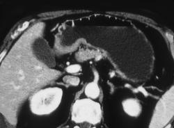 Antral Carcinoma - CTisus CT Scan