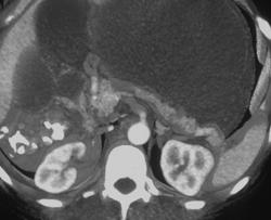 Gastric Outlet Obstruction With Duodenal Cancer - CTisus CT Scan