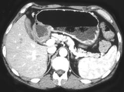 Antral Carcinoma - CTisus CT Scan