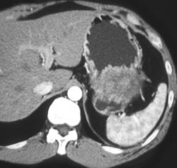 GIST Tumor - CTisus CT Scan