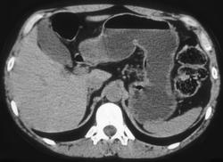 Gastric Fundus Creates Pseudotumor and Simulates An Adrenal Mass - CTisus CT Scan