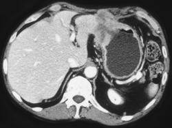 Recurrent Gastric Cancer - CTisus CT Scan