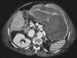 Hemorrhagic Gastritis - CTisus CT Scan