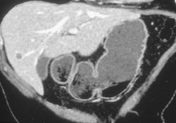 Normal Gastric Folds - CTisus CT Scan