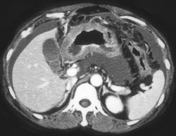 Antral Cancer With Carcinomatosis - CTisus CT Scan