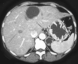 Prominent Gastric Folds - CTisus CT Scan