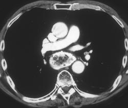 Gastric Pull-up - CTisus CT Scan