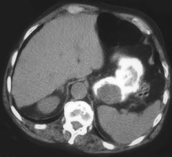 Ulcerating GIST Tumor - CTisus CT Scan