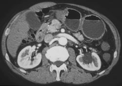 Antral Carcinoma - CTisus CT Scan