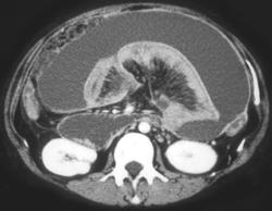 Carcinomatosis Due to Gastric Cancer - CTisus CT Scan