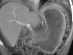 Thickened Gastric Folds - CTisus CT Scan