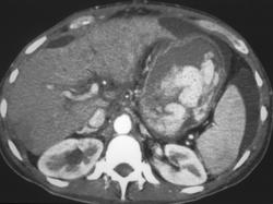 Cirrhosis With Delayed Gastric Emptying - CTisus CT Scan