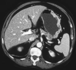 Gastritis - CTisus CT Scan