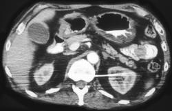 Antral Carcinoma - CTisus CT Scan