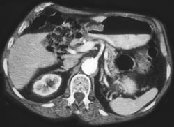 Antral Carcinoma - CTisus CT Scan