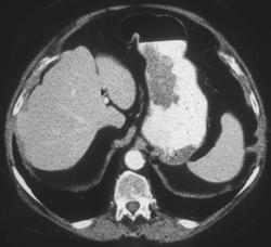 Bezoar - CTisus CT Scan