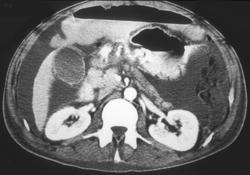 Carcinomatosis - CTisus CT Scan