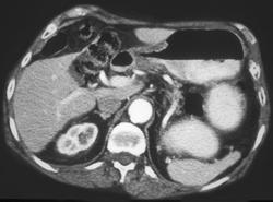 Antral Cancer - CTisus CT Scan