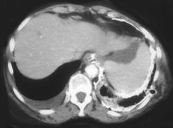 Perforation at Gastroesophageal (GE) Junction With Leak - CTisus CT Scan