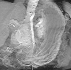 Normal Gastric Folds - CTisus CT Scan