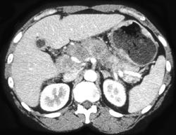 Gastric Cancer With Nodes Involving the Pancreas - CTisus CT Scan