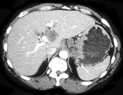 Gastric Cancer With Celiac and Peri-portal Adenopathy - CTisus CT Scan