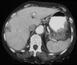 Gastric Adenocarcinoma With Celiac Nodes and Liver Metastases - CTisus CT Scan