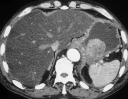 Bulky Gastric Cancer - CTisus CT Scan