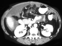 Carcinomatosis - CTisus CT Scan