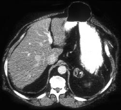 Hernia of the Stomach Through Abdominal Wall Defect - CTisus CT Scan