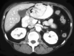 Gastric Adenocarcinoma - CTisus CT Scan